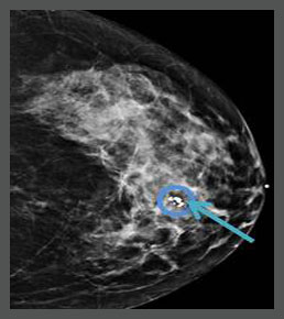 mammography practice tests